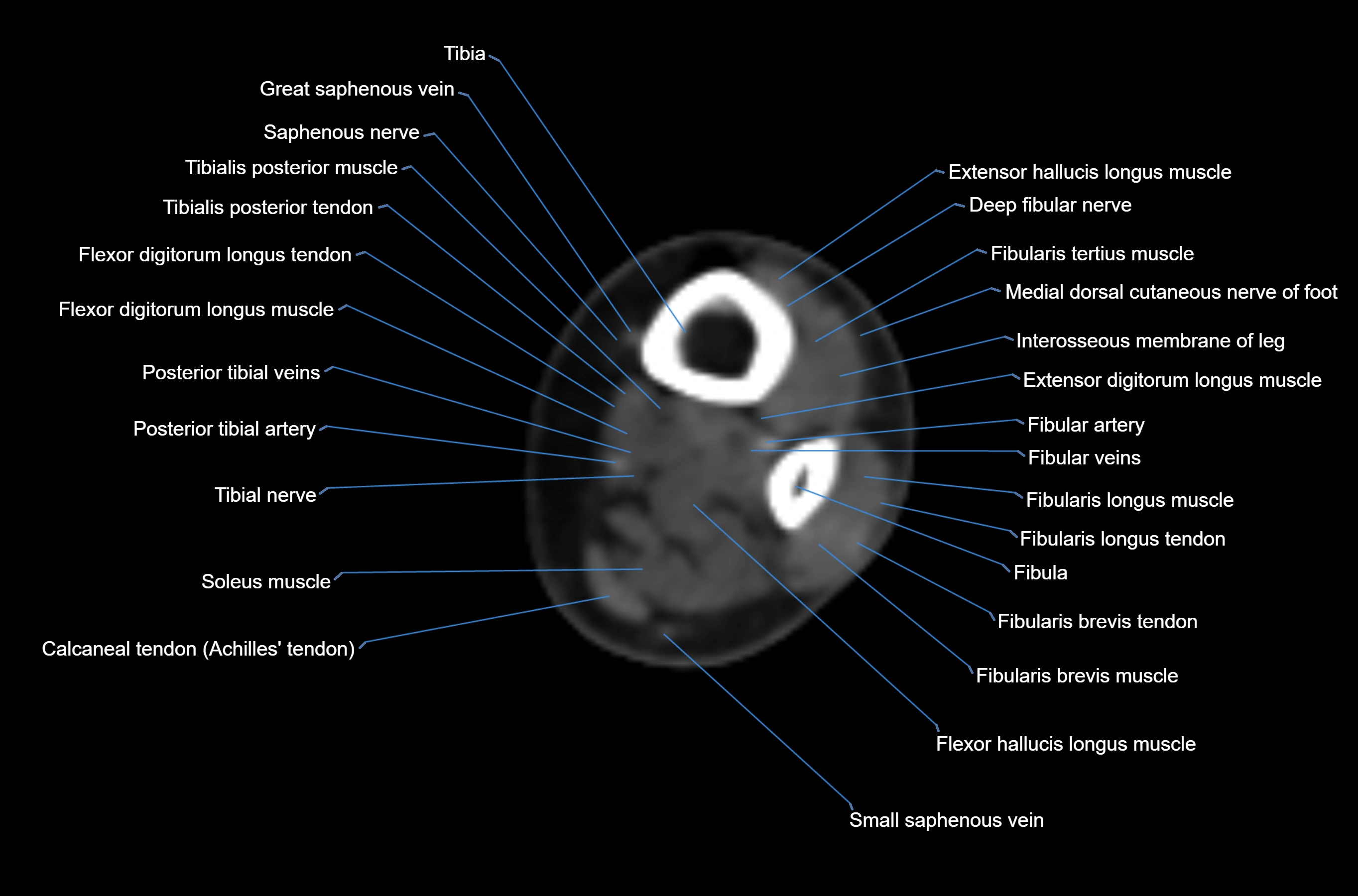 CT Ankle axial cross sectional anatomy labelled image -00005.webp